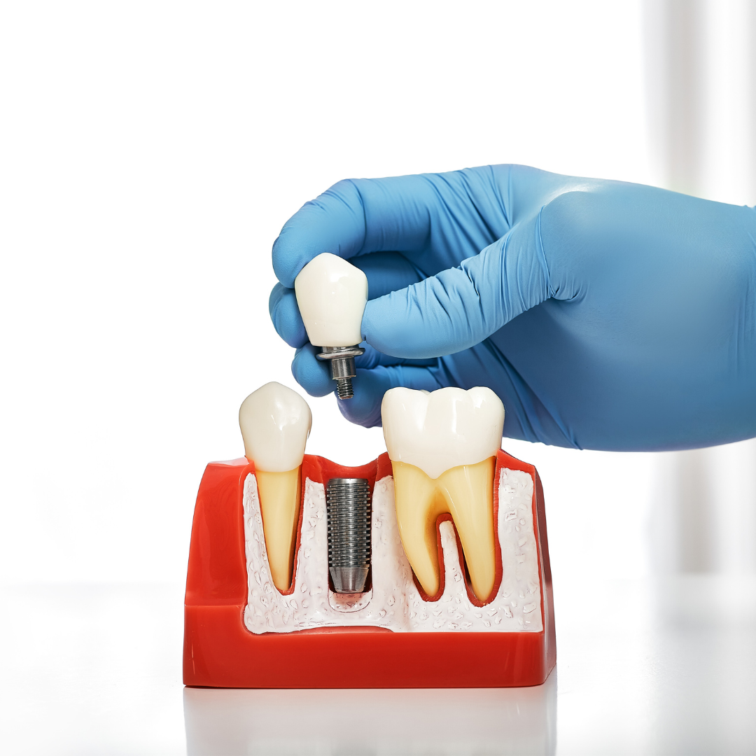 The Comprehensive Guide to Dental Implants at Crown Dental Inglewood