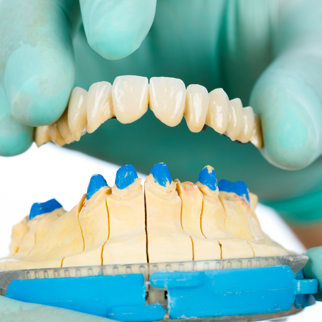 Restoring Smiles: Exploring the Art of Dental Crowns and Bridges