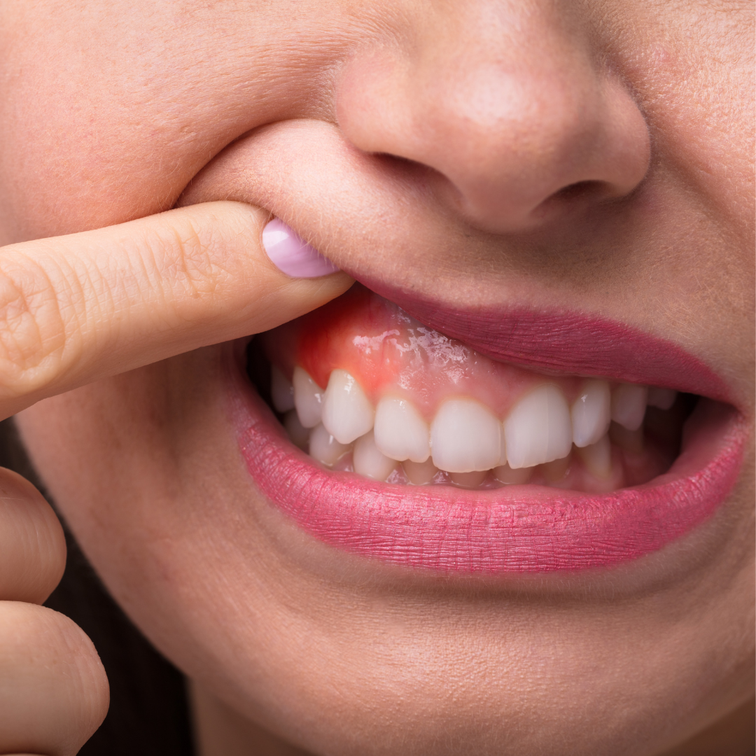 Understanding Gum Disease: Protect Your Smile with Dr. Barooty & Dr. Bandary at Crown Dental Inglewood