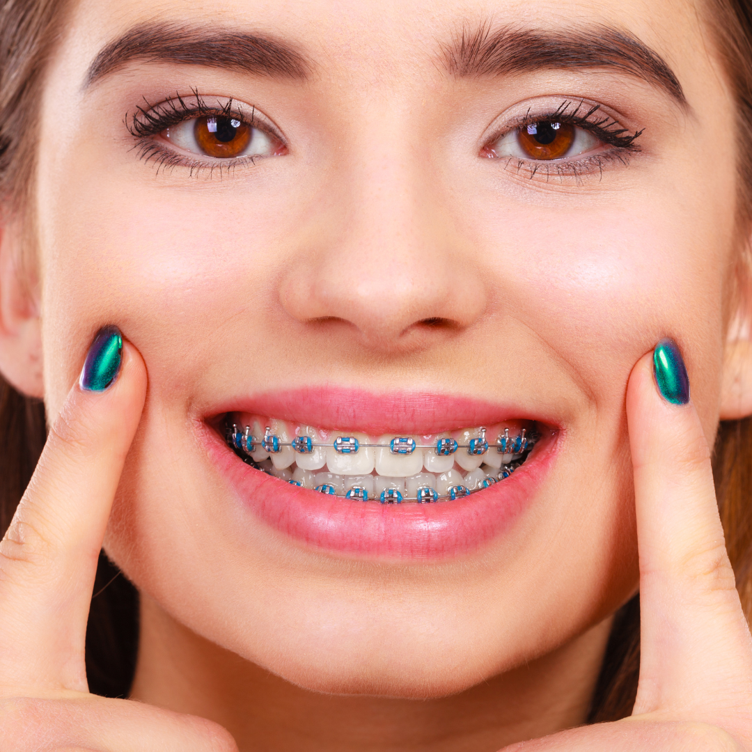Braces: Your Pathway to a Straighter, Healthier Smile
